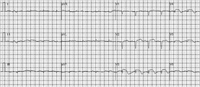 Case report: Takotsubo syndrome induced by severe hypoglycemia